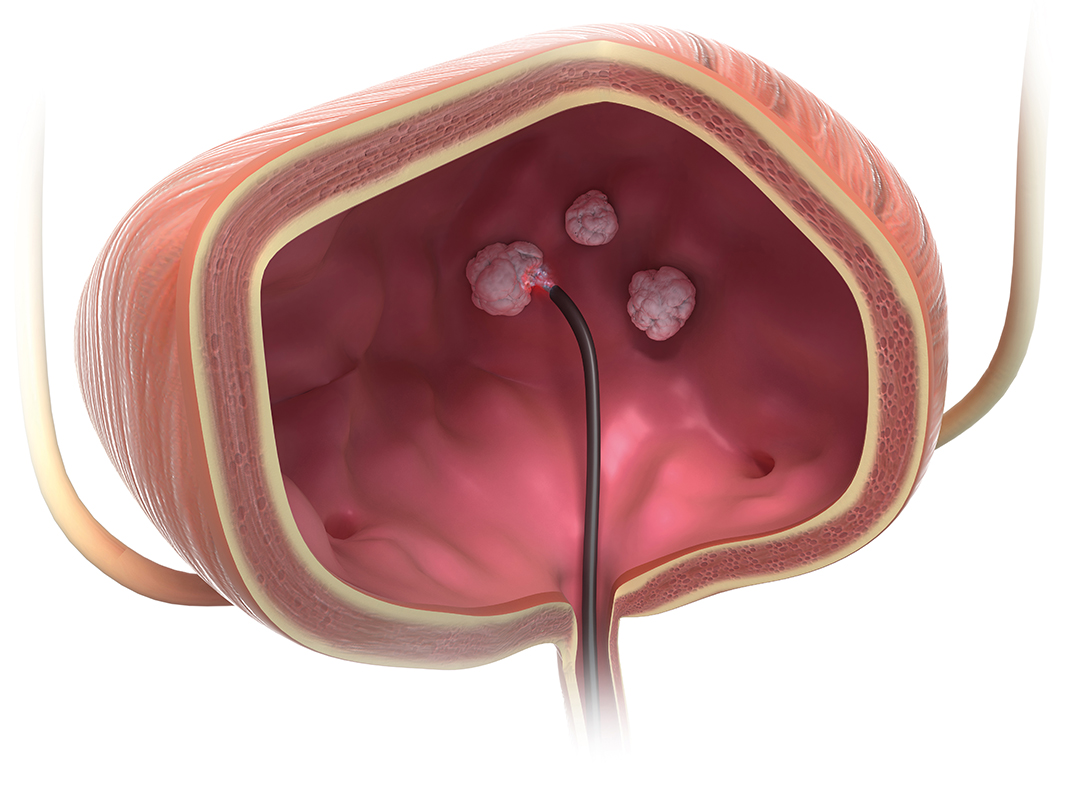 Female doctor during a urological laser therapy procedure  